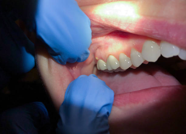 Best Emergency Dentist for Knocked-Out Tooth in Callaway, MD