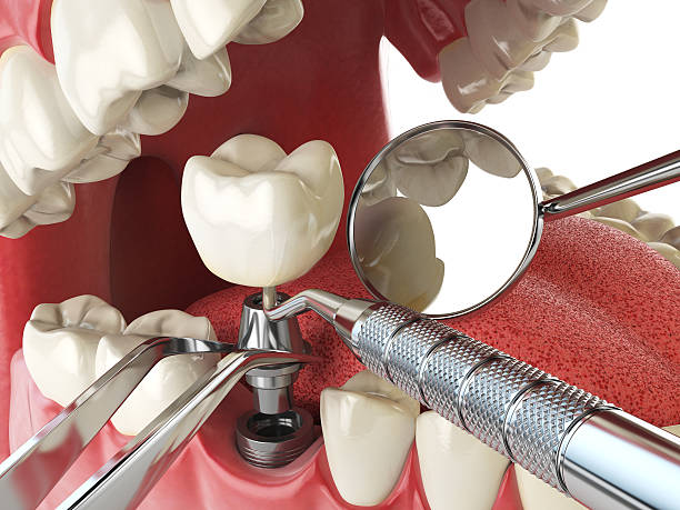 Best Emergency Root Canal Treatment in Callaway, MD