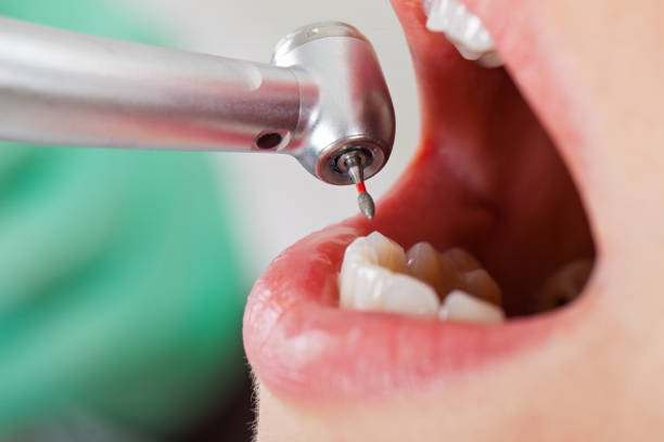 Best Emergency Dental Care for Abscessed Tooth in Callaway, MD